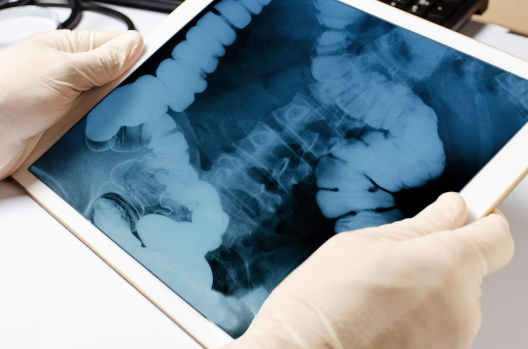 The Gut Microbiome’s Role in Skeletal Health