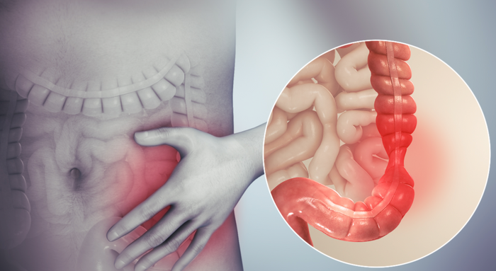 What causes IBS?